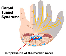 carpal-tunnel