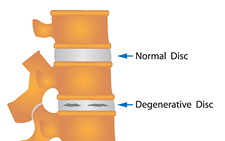 degenerative-disc