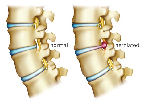 herniated-disc