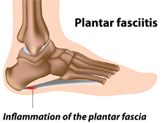 plantar-fasciitis