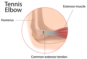 tennis-elbow