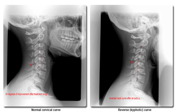 xrayneck